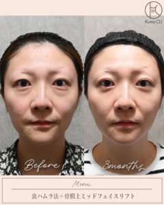 裏ハムラ法＋骨膜上ミッドフェイスリフト