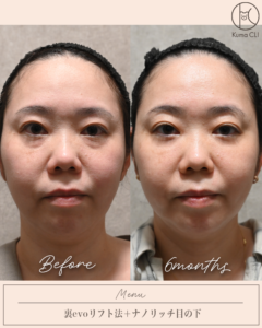 裏evoリフト法＋ナノリッチ目の下