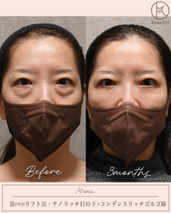 裏evoリフト法＋ナノリッチ目の下＋コンデンスリッチゴルゴ線