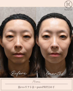 裏evoリフト法＋purePRP目の下