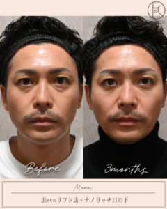 裏evoリフト法＋ナノリッチ目の下