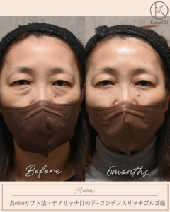 表evoリフト法＋ナノリッチ目の下＋コンデンスリッチゴルゴ線