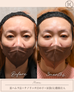 裏ハムラ法＋ナノリッチ目の下＋涙袋(左)脂肪注入