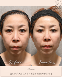 表ミッドフェイスリフト法＋purePRP目の下
