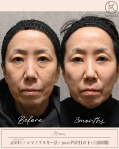 表ミッドフェイスリフト＋シマノフスキー法＋purePRP目の下＋目頭切開