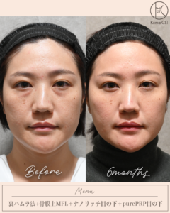 裏ハムラ法＋骨膜上ミッドフェイスリフト＋ナノリッチ＋purePRP目の下