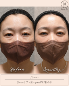 裏evoリフト法＋purePRP目の下