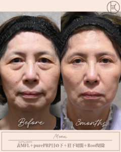 表ミッドフェイスリフト＋purePRP目の下＋眉下切開＋Roof切除