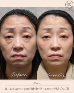 裏ハムラ法evo＋purePRP目の下＋growthPRPゴルゴ線