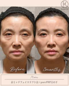 表ミッドフェイスリフト法＋purePRP目の下